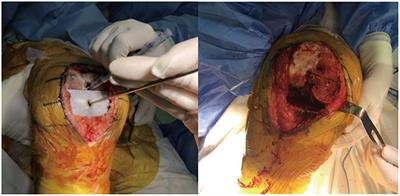 Influence of Patella Position on Soft Tissue Balance and Clinical Outcomes in Patients Undergoing Minimally Invasive Total Knee Arthroplasty, a Randomized Clinical Trial